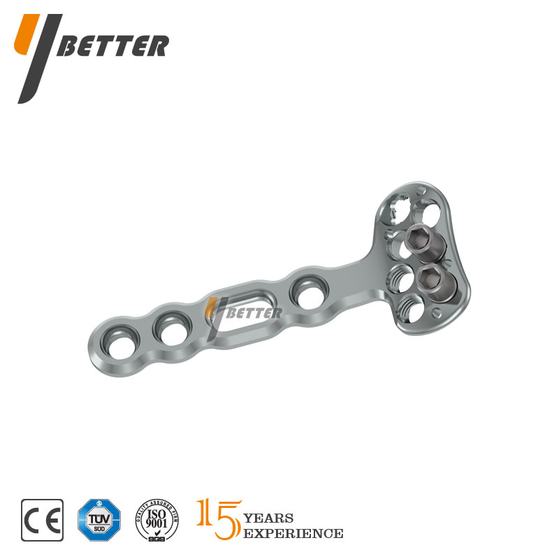 Y-DVR橈骨遠(yuǎn)端掌側(cè)接骨板