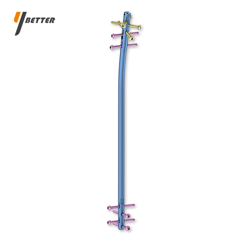 專家級脛骨帶鎖髓內(nèi)釘