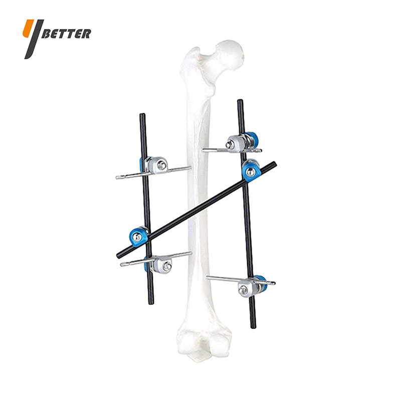 股骨干骨折固定支架